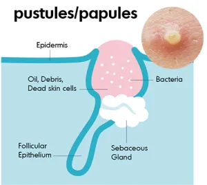 Gambar Jerawat Pustula | Sumber: SLMD Skincare