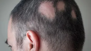 Alopecia Areata