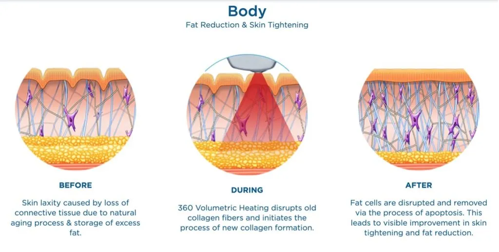 Cara Kerja Prosedur Exilis