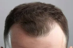 Gambar Garis Rambut Mulai Mundur