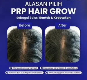 Hasil Before and After PRP Hair Grow Sozo Skin Clinic