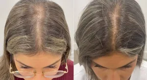 Telogen Effluvium