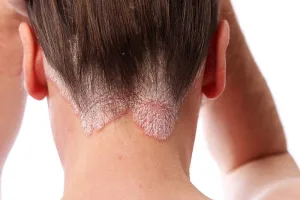 Tinea Capitis
