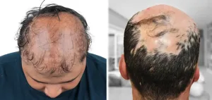 Cicatricial Alopecia