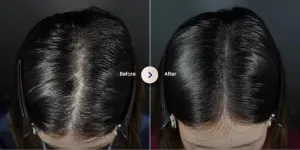 Before dan After PRP Treatment untuk Rambut di Sozo Skin Clinic