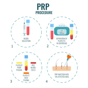 Cara Kerja PRP Treatment