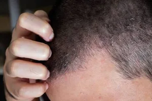 Gejala Dermatitis Seboroik