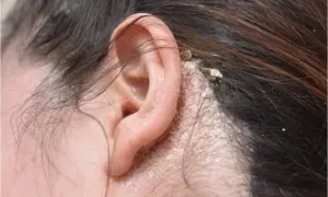 Kondisi Penyakit Dermatitis Seboroik