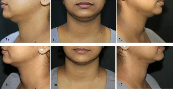 double chin | source: pmc.ncbi.nlm.nih.gov