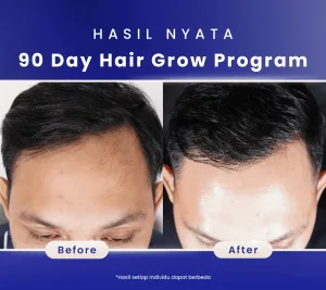 Hasil Hair Treatment di Sozo Skin Clinic