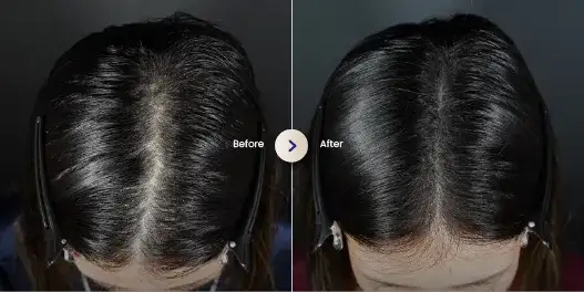 pengobatan rambut rontok