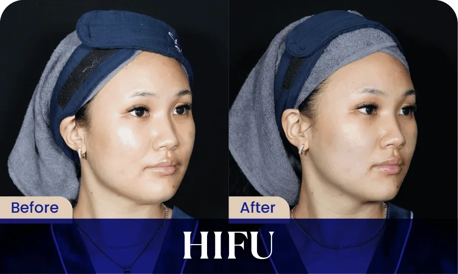 Hifu Treatment di Sozo Skin Clinic