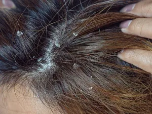 Kondisi Dermatitis Seboroik