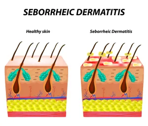 Perbandingan Kulit Normal dan Dermatitis Seboroik