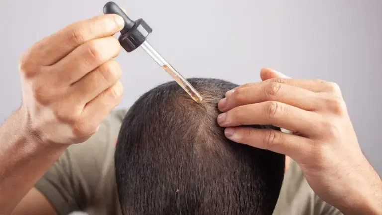 Efek Samping Minoxidil Jangka Panjang & Solusi Kebotakan Rambut yang Aman