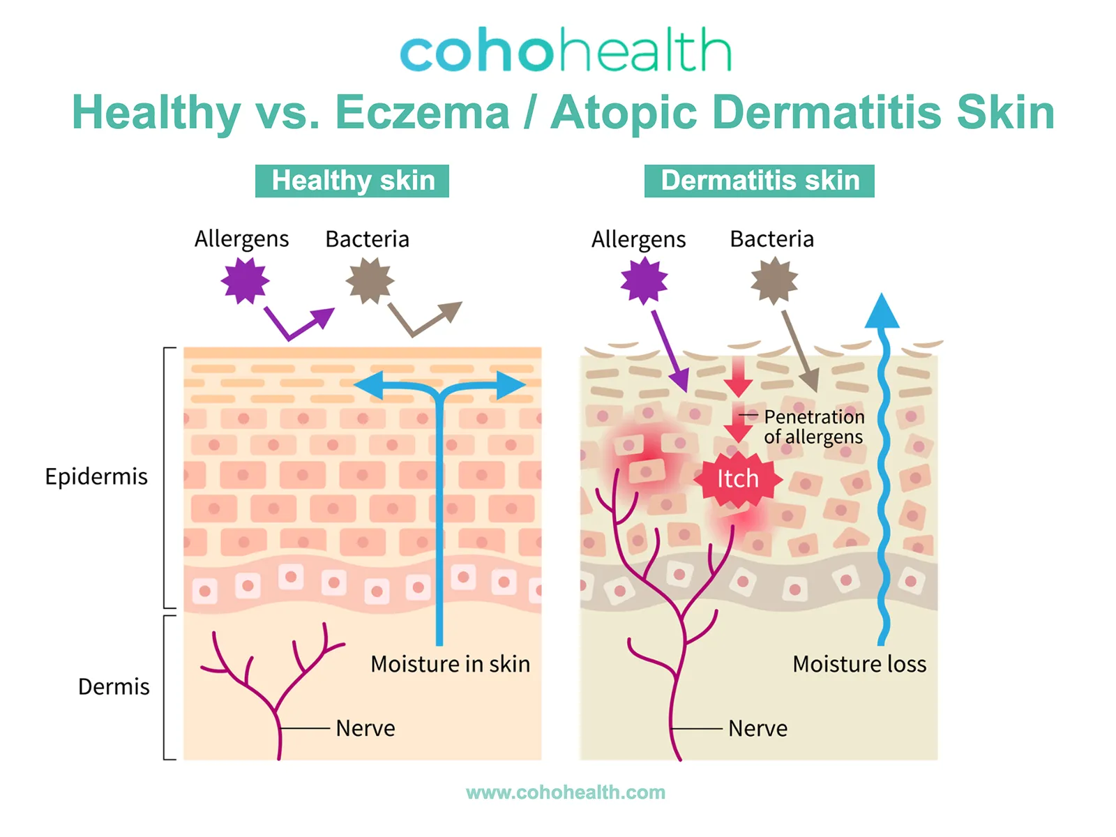 Eksim Atopik (Dermatitis Atopik): Gejala & Cara Mengatasinya