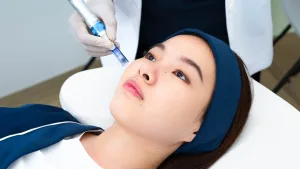 Ilustrasi Prosedur PRP Treatment untuk Wajah