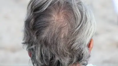 Marie Antoinette Syndrome: Benarkah Rambut Bisa Memutih dalam Semalam?