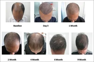 Siklus Pertumbuhan Rambut Hasil PRP