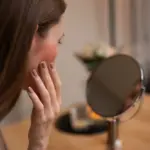 Rosacea: Penyebab, Gejala, dan Cara Mengatasinya