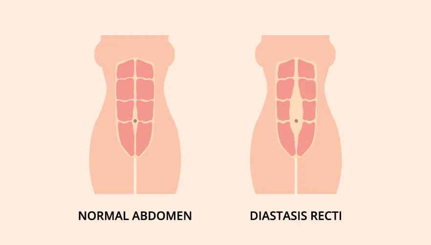 Diastasis Recti