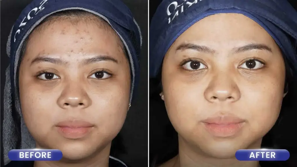 Hasil Acne Treatment di Sozo Skin Clinic