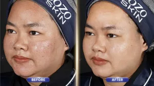 Hasil Acne Treatment untuk Bekas Bopeng