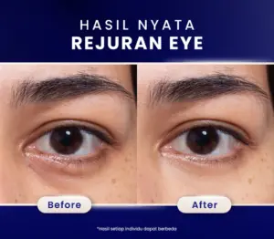 Hasil Treatment Rejuran Eye
