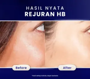 Hasil Treatment Rejuran HB