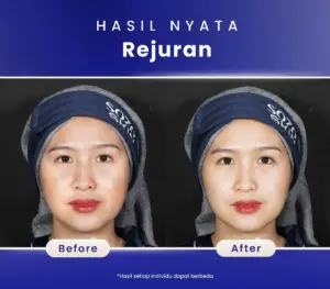 Hasil Treatment Rejuran Healer