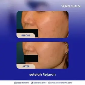 Hasil Treatment Rejuran Scar