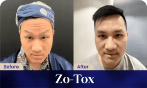 Hasil Treatment Zo-Tox di Sozo Skin Clinic