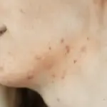 Muncul Jerawat di Leher? Kenali Penyebab & Cara Menghilangkannya secara Cepat