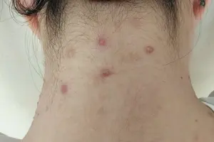 Jerawat di Leher Belakang