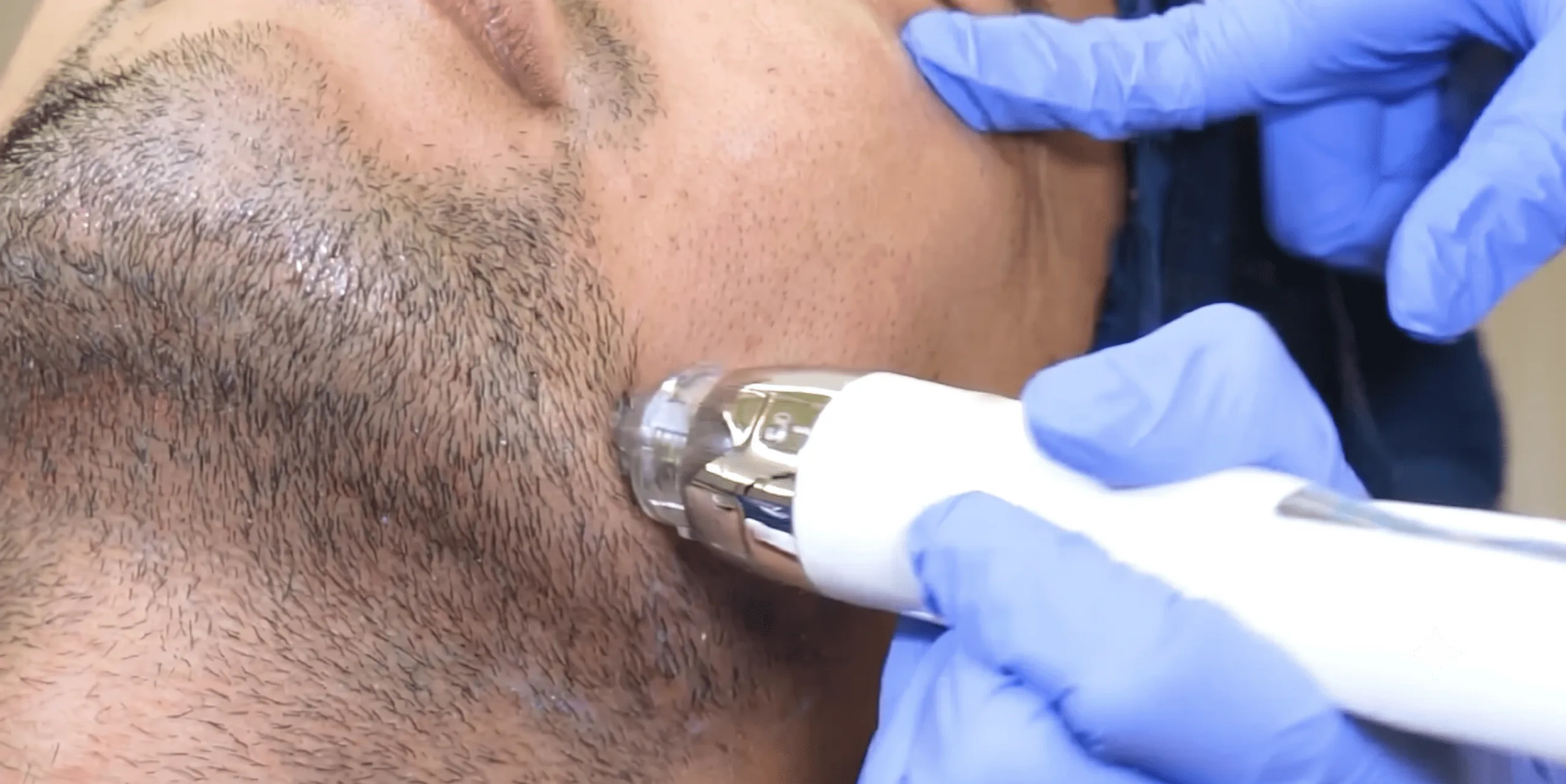 Treatment penumbuh brewok pria (Beard Grow) dengan microneedling di Sozo Skin Clinic
