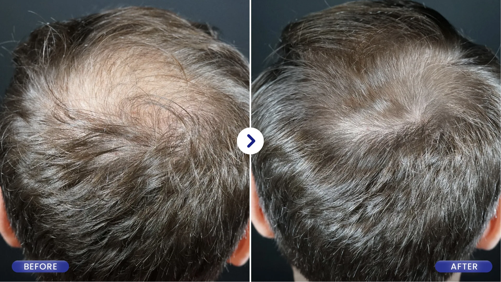 Before After PRP Hair Treatment Kebotakan Pria SOZO Clinic