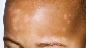 Pityriasis Alba