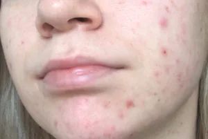 Post-Inflammatory Erythema 