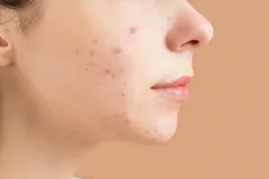 Post-inflammatory Hyperpigmentation