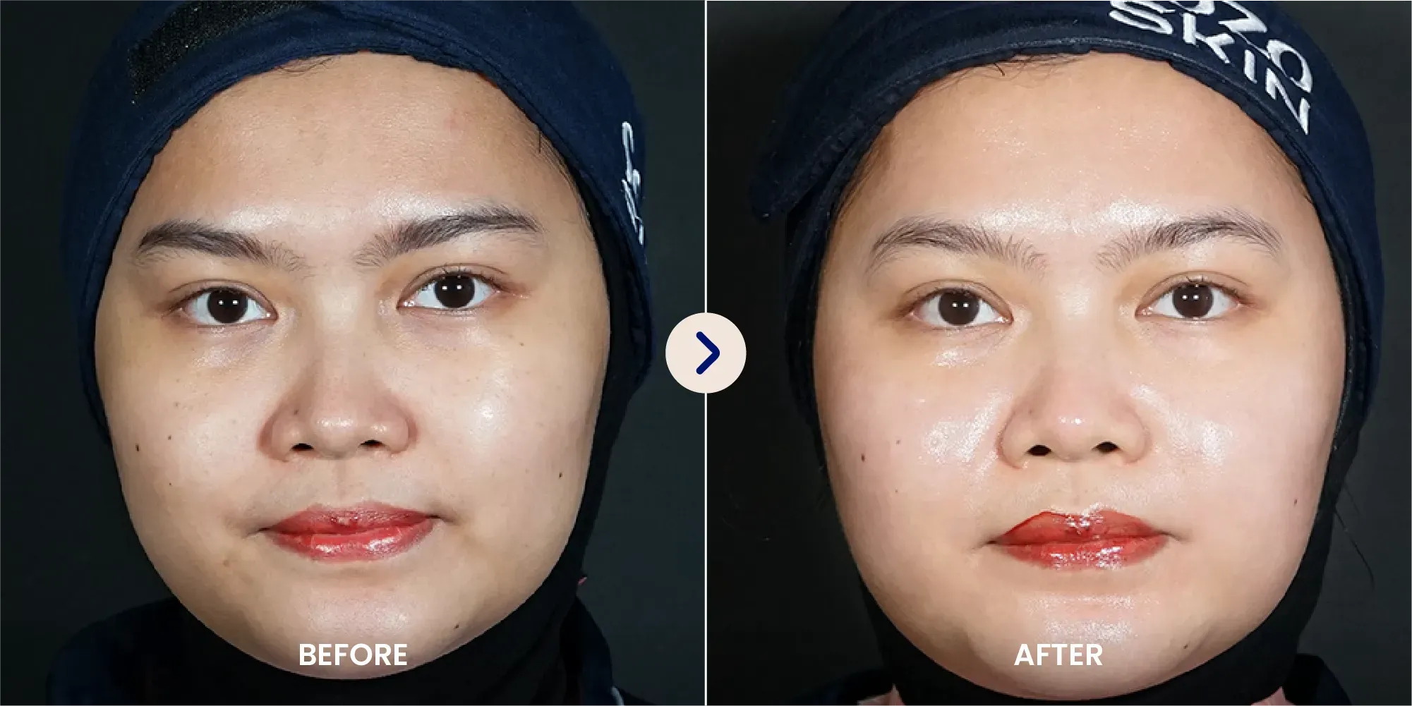 Skin Booster Treatment Before vs After