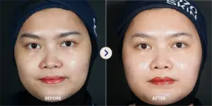 Skin Booster Treatment di Sozo Skin Clinic