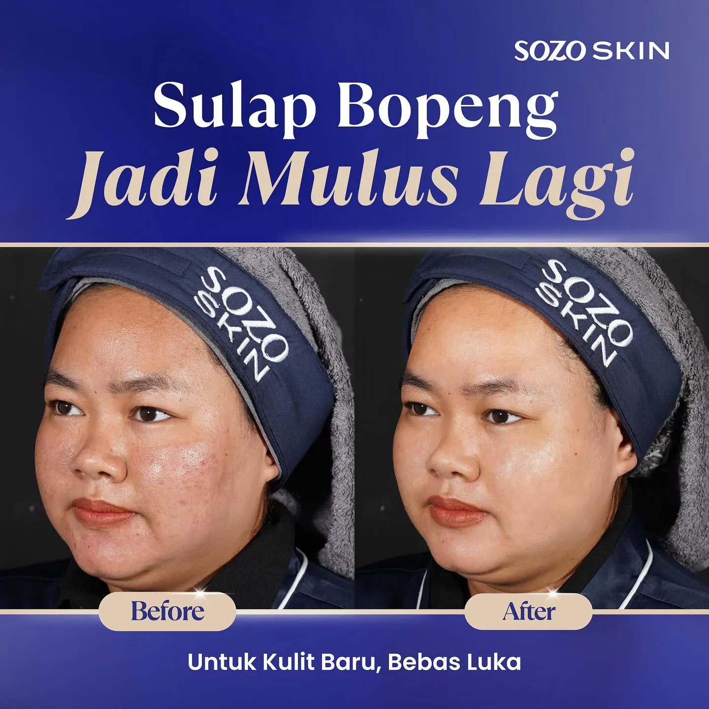 Treatment untuk Bopeng di Sozo Skin Clinic