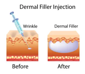 Cara Kerja Filler Wajah