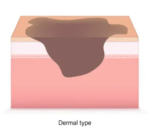 Jenis Dermal Melasma