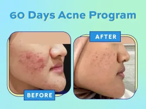 Hasil Acne Treatment di Sozo Skin Clinic