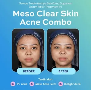 Hasil Dark Spot Treatment Sozo Skin Clinic