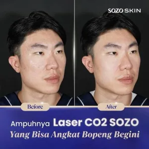 Hasil Laser Treatment di Sozo Skin Clinic