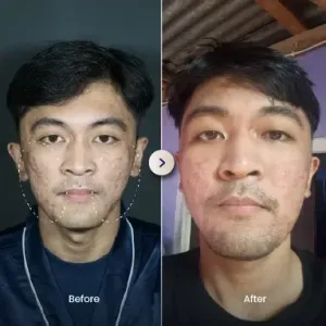 Hasil Laser Treatment Sozo Skin Clinic