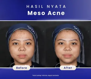 Hasil Meso Acne Treatment Sozo Skin Clinic