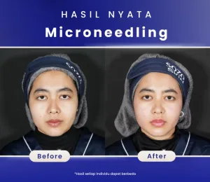 Hasil Microneedling Treatment di Sozo Skin Clinic